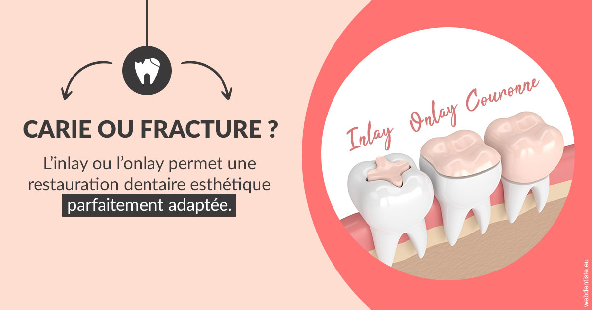 https://dr-alexandre-fevre.chirurgiens-dentistes.fr/T2 2023 - Carie ou fracture 2