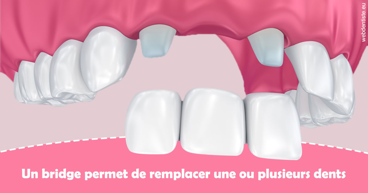 https://dr-alexandre-fevre.chirurgiens-dentistes.fr/Bridge remplacer dents 2