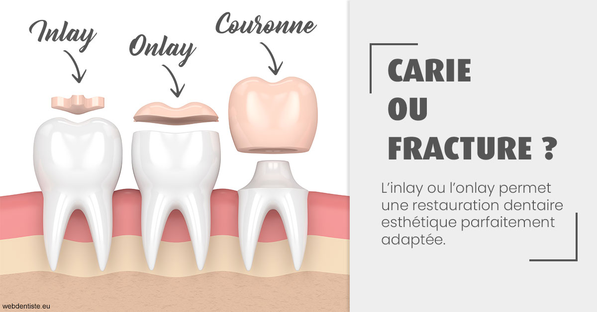 https://dr-alexandre-fevre.chirurgiens-dentistes.fr/T2 2023 - Carie ou fracture 1
