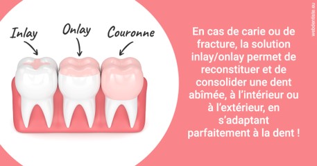 https://dr-alexandre-fevre.chirurgiens-dentistes.fr/L'INLAY ou l'ONLAY 2