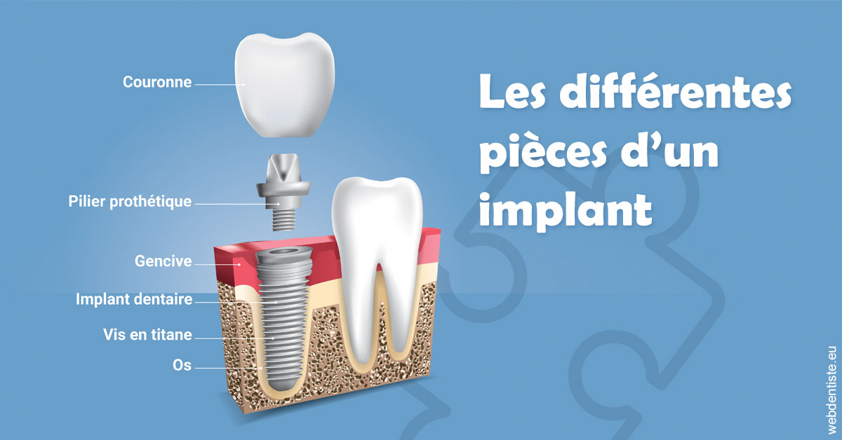 https://dr-alexandre-fevre.chirurgiens-dentistes.fr/Les différentes pièces d’un implant 1
